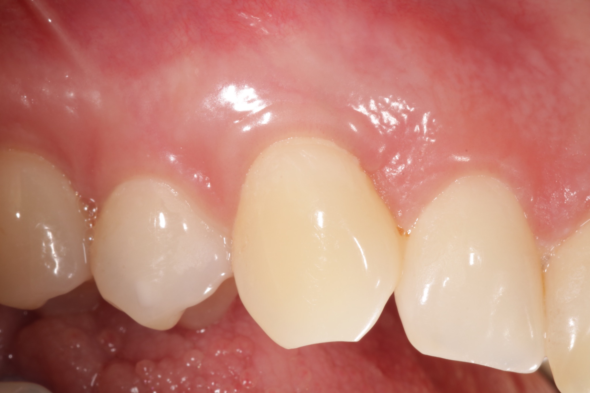 before and after periodontal treatment