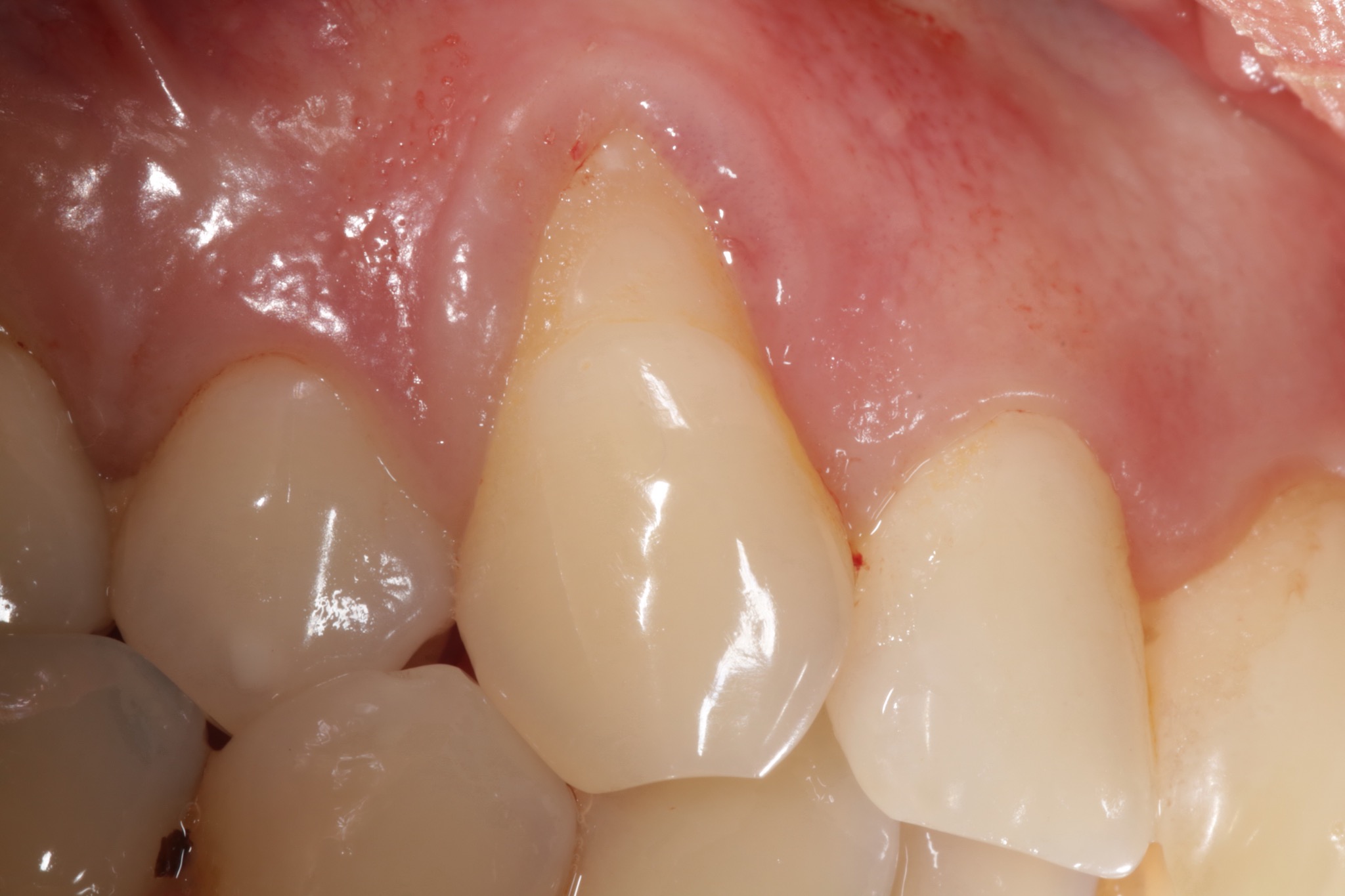 before and after periodontal treatment