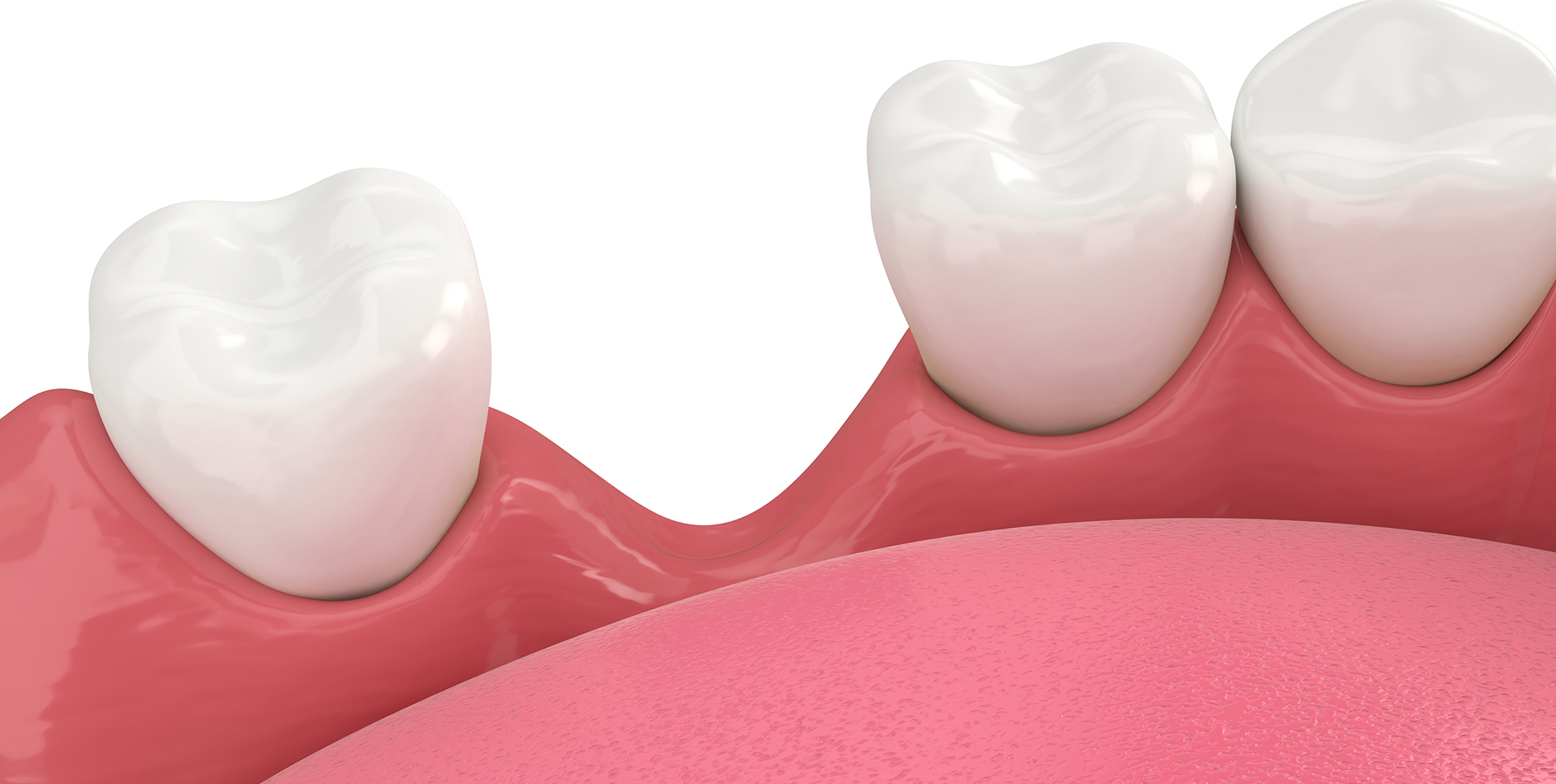3d render of jaw bone recession after loosing tooth