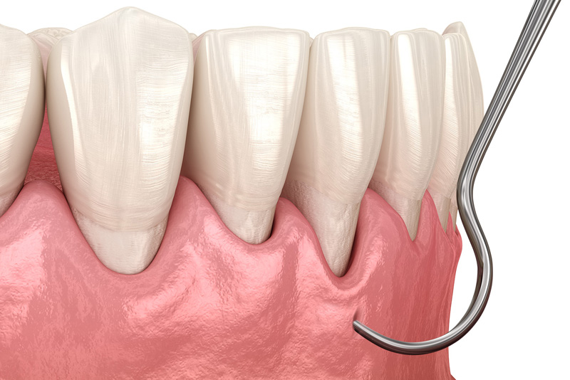 gum recession before pinhole technique