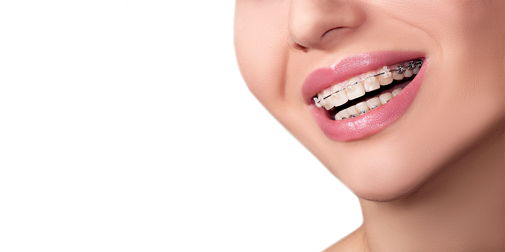 stock image of close up of patient wearing braces