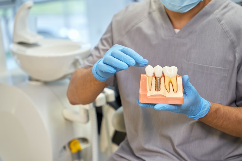 a periodontist holding a dental implant model.