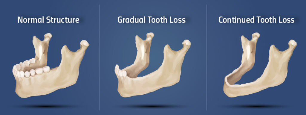 Bone Loss Illustration Showing Normal Bone Structure Slowly Decaying Without Teeth