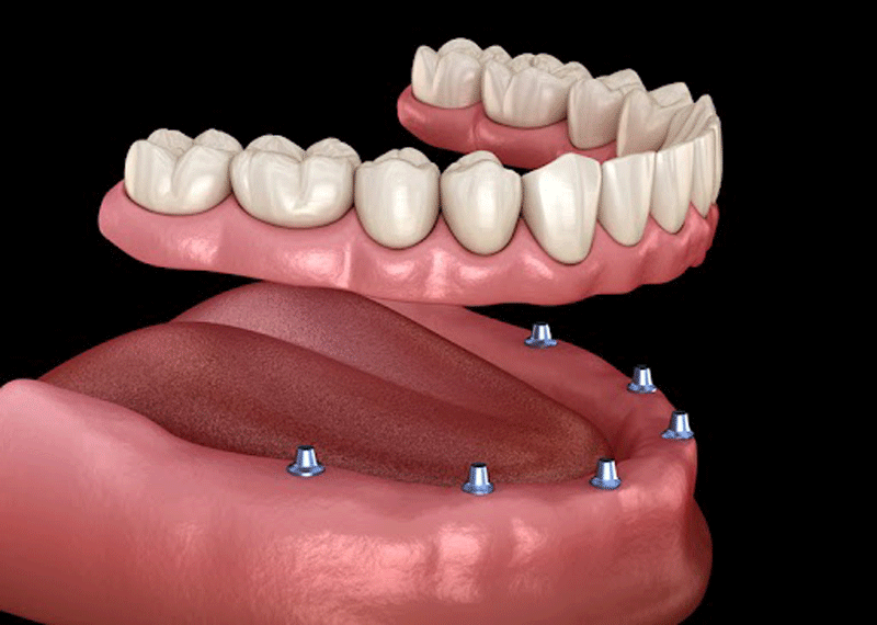 an image of a 3D dental implant model.