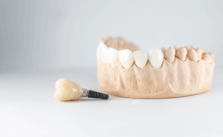 Dental implant in front of lower mouth model