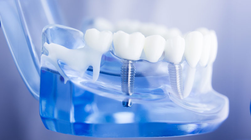 The image shows a dental implant model with a transparent blue lower jaw and white teeth, demonstrating the mechanics of dental implants in dentistry.