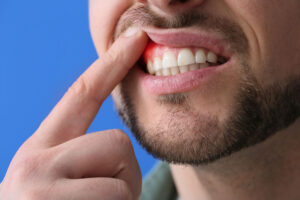 A man with a beard points to inflamed gums, indicating gum disease. His expression shows discomfort, and the background is blue.