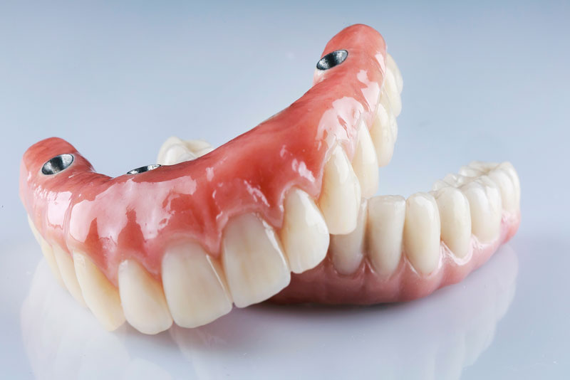 full mouth dental implant prosthesis model.