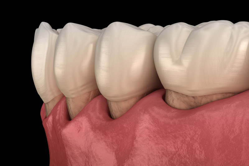 gum recession showing on the lower gum line.