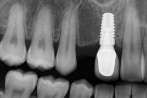 A close up x-ray of a patients mouth where a molar is missing, then an implant molar is placed in the open space. No text on the image.