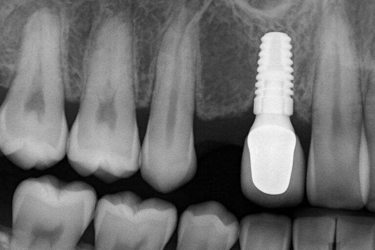 A close up x-ray of a patients mouth where a molar is missing, then an implant molar is placed in the open space. No text on the image.