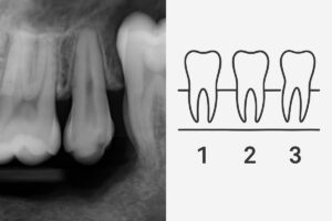 A close-up x-ray of a patient's mouth, highlighting a tooth with significant bone loss and mobility, next to a diagram of the tooth grading scale from 1-3. No text on image.