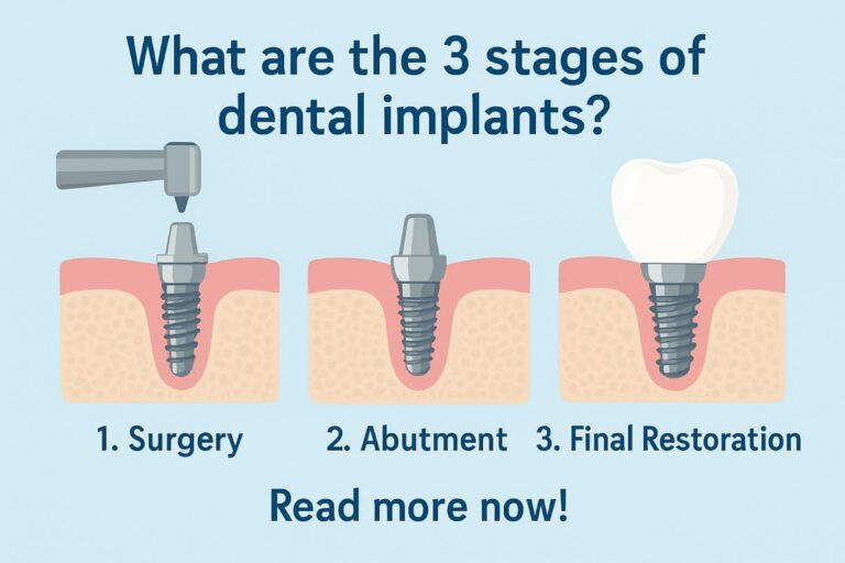 Image depicting the three stages of dental implants: the implant placement, osseointegration and healing, and the final restoration with a crown. No text on image.
